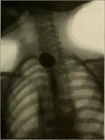 An illustration from A text-book of radiology (1915)