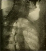 An illustration from A text-book of radiology (1915)