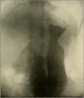 An illustration from A text-book of radiology (1915)