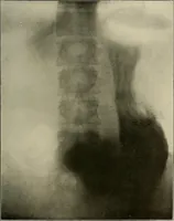 An illustration from A text-book of radiology (1915)