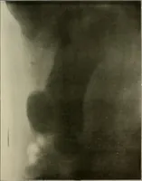 An illustration from A text-book of radiology (1915)