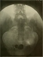 An illustration from A text-book of radiology (1915)