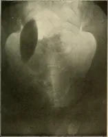 An illustration from A text-book of radiology (1915)