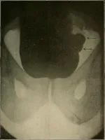 An illustration from A text-book of radiology (1915)
