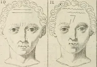 An illustration from Traicté povr la conservation de la santé, et svr la saignee de ce temps, et moyen de remedier aux maladies sans craincte de leur recheute : auec autres traictez necessaires pour toutes sortes de personnes, en façon & ordre non encores veus, & selon la doctrine des anciens medecins grecs, arabes, latins & françois : avgmenté d'vn Traicté de Galien, de l'alictement des malades : Apologie contre Iean Terud ... : Examen du liure intitulé Medecin charitable : Traicté de la physiognomie, auec les figures propres, qui sont au nombre de 53 ... (1650)