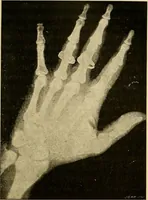 An illustration from Traité de radiographie médicale et scientifique : cours libre professé a l'écolepratique de la Faculté de Médecine de Paris, deuxième semestre de 1896-1897 (1897)