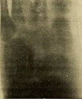 An illustration from Traité de radiographie médicale et scientifique : cours libre professé a l'écolepratique de la Faculté de Médecine de Paris, deuxième semestre de 1896-1897 (1897)