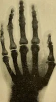 An illustration from Traité de radiographie médicale et scientifique : cours libre professé a l'écolepratique de la Faculté de Médecine de Paris, deuxième semestre de 1896-1897 (1897)