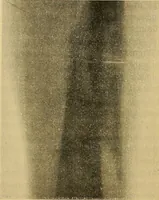 An illustration from Traité de radiographie médicale et scientifique : cours libre professé a l'écolepratique de la Faculté de Médecine de Paris, deuxième semestre de 1896-1897 (1897)