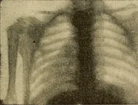 An illustration from Traité de radiographie médicale et scientifique : cours libre professé a l'écolepratique de la Faculté de Médecine de Paris, deuxième semestre de 1896-1897 (1897)