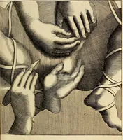 An illustration from Traite' de la lithotomie, ou, De l'extraction de la pierre, hors de la vessie : enrichy de figures necessaires pour representer la maniére de sonder, les instrumens propres, le malade dans l'operation : la ponction du perinée, & les differentes methodes de tirer la pierre : avec les appareils, les remedes preservatifs du calcul, & les medicamens pour les taillez (1686)