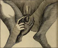 An illustration from Traite' de la lithotomie, ou, De l'extraction de la pierre, hors de la vessie : enrichy de figures necessaires pour representer la maniére de sonder, les instrumens propres, le malade dans l'operation : la ponction du perinée, & les differentes methodes de tirer la pierre : avec les appareils, les remedes preservatifs du calcul, & les medicamens pour les taillez (1686)