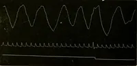 An illustration from Treatment by hypnotism and suggestion : or, psycho-therapeutics (1900)