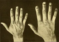 An illustration from Études biologiques sur les géants (1904)