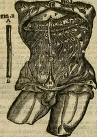 An illustration from The workes of that famous chirurgion Ambrose Parey : (1649)