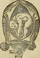 Picture 229 of 336 from The workes of that famous chirurgion Ambrose Parey : (1649), leaf 636