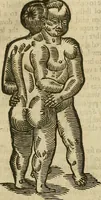 Picture 254 of 336 from The workes of that famous chirurgion Ambrose Parey : (1649), leaf 687