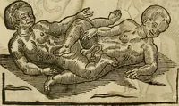 Picture 256 of 336 from The workes of that famous chirurgion Ambrose Parey : (1649), leaf 687