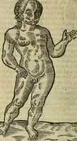 Picture 271 of 336 from The workes of that famous chirurgion Ambrose Parey : (1649), leaf 695