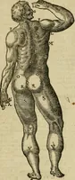 An illustration from The workes of that famous chirurgion Ambrose Parey : (1649)