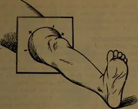 An illustration from X-ray manual : U.S. Army (1917)