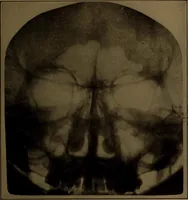 An illustration from X-ray manual : U.S. Army (1917)