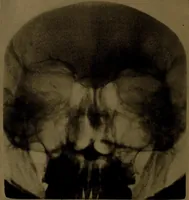An illustration from X-ray manual : U.S. Army (1917)
