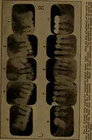 An illustration from X-ray manual : U.S. Army (1917)