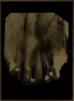 An illustration from X-ray manual : U.S. Army (1917)