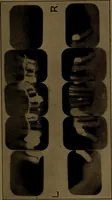 An illustration from X-ray manual : U.S. Army (1917)