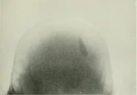 An illustration from X-rays, how to produce and interpret them (1915)