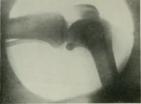 An illustration from X-rays, how to produce and interpret them (1915)