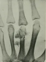 An illustration from X-rays, how to produce and interpret them (1915)