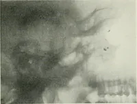 An illustration from X-rays, how to produce and interpret them (1915)