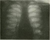 Picture 27 of 76 from X-rays, how to produce and interpret them (1915), leaf 116