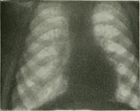 Picture 28 of 76 from X-rays, how to produce and interpret them (1915), leaf 120