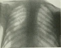 Picture 29 of 76 from X-rays, how to produce and interpret them (1915), leaf 120