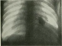 An illustration from X-rays, how to produce and interpret them (1915)