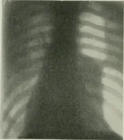 Picture 31 of 76 from X-rays, how to produce and interpret them (1915), leaf 127