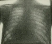 An illustration from X-rays, how to produce and interpret them (1915)