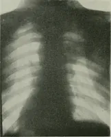 An illustration from X-rays, how to produce and interpret them (1915)