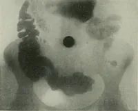 An illustration from X-rays, how to produce and interpret them (1915)