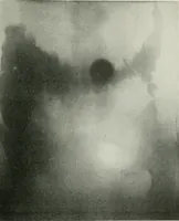 An illustration from X-rays, how to produce and interpret them (1915)