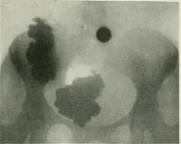 An illustration from X-rays, how to produce and interpret them (1915)