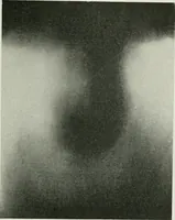 An illustration from X-rays, how to produce and interpret them (1915)