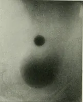 An illustration from X-rays, how to produce and interpret them (1915)