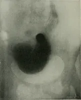 An illustration from X-rays, how to produce and interpret them (1915)
