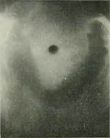 An illustration from X-rays, how to produce and interpret them (1915)