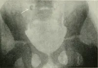 An illustration from X-rays, how to produce and interpret them (1915)