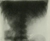An illustration from X-rays, how to produce and interpret them (1915)